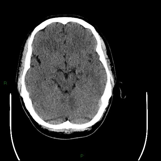 Acute posterior cerebral artery territory infarct (Radiopaedia 79329-92393 Axial non-contrast 40).jpg