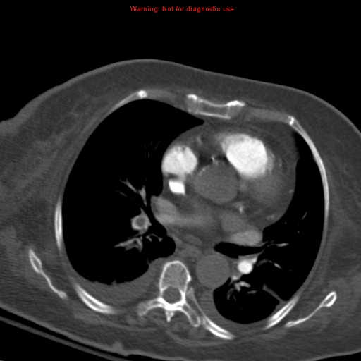 Acute pulmonary embolism (Radiopaedia 13286-13289 Axial C+ CTPA 35).jpg
