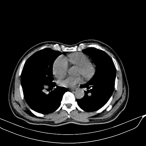 File:Acute pulmonary embolism (Radiopaedia 69510-79390 Axial non-contrast 37).jpg