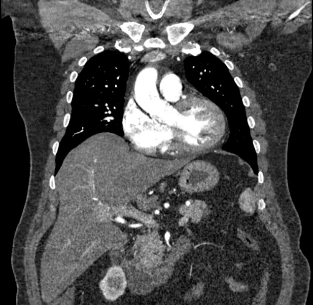 Acute pulmonary embolism with pulmonary infarcts (Radiopaedia 77688-89908 Coronal C+ CTPA 27).jpg