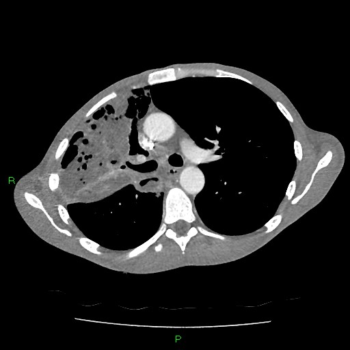 File:Acute right lung abscess (Radiopaedia 34806-36258 Axial C+ arterial phase 73).jpg