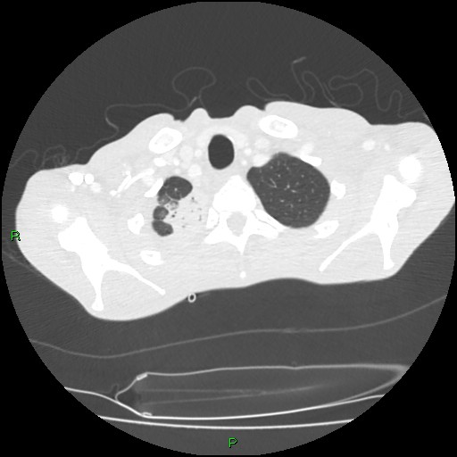 Acute right lung abscess (Radiopaedia 34806-36258 Axial lung window 15).jpg