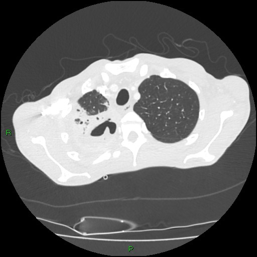 Acute right lung abscess (Radiopaedia 34806-36258 Axial lung window 30).jpg