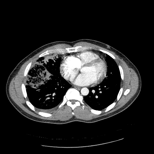 Acute segmental pulmonary emboli and pulmonary infarction (Radiopaedia 62264-70444 Axial C+ CTPA 73).jpg
