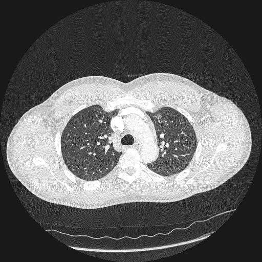 Acute segmental pulmonary emboli and pulmonary infarction (Radiopaedia 62264-70444 Axial lung window 53).jpg
