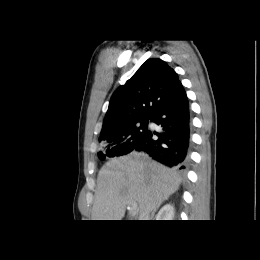 File:Acute segmental pulmonary emboli and pulmonary infarction (Radiopaedia 62264-70444 Sagittal C+ CTPA 23).jpg