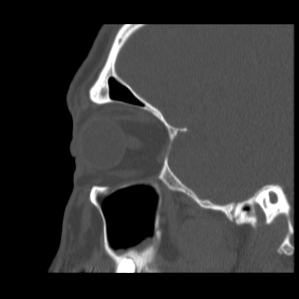 Acute sinusitis (Radiopaedia 23161-23215 Sagittal bone window 18).jpg
