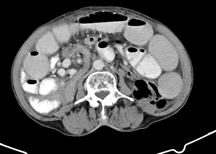 Acute small bowel (ileal) volvulus (Radiopaedia 71740-82139 Axial C+ portal venous phase 110).jpg