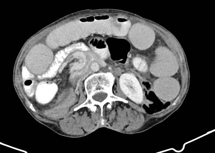Acute small bowel (ileal) volvulus (Radiopaedia 71740-82139 Axial C+ portal venous phase 98).jpg
