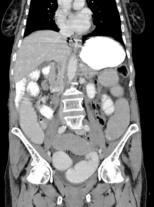 Acute small bowel (ileal) volvulus (Radiopaedia 71740-82139 Coronal C+ portal venous phase 58).jpg