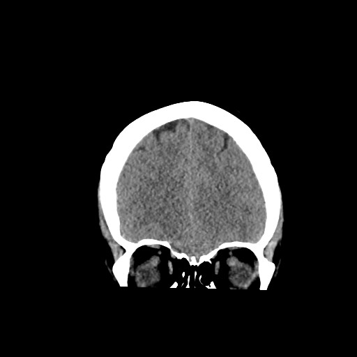 Acute subarachnoid hemorrhage and accessory anterior cerebral artery (Radiopaedia 69231-79008 Coronal non-contrast 20).jpg