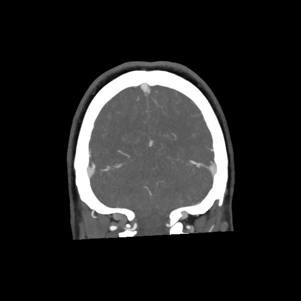 Acute subarachnoid hemorrhage and accessory anterior cerebral artery (Radiopaedia 69231-79009 Coronal C+ arterial phase 65).jpg