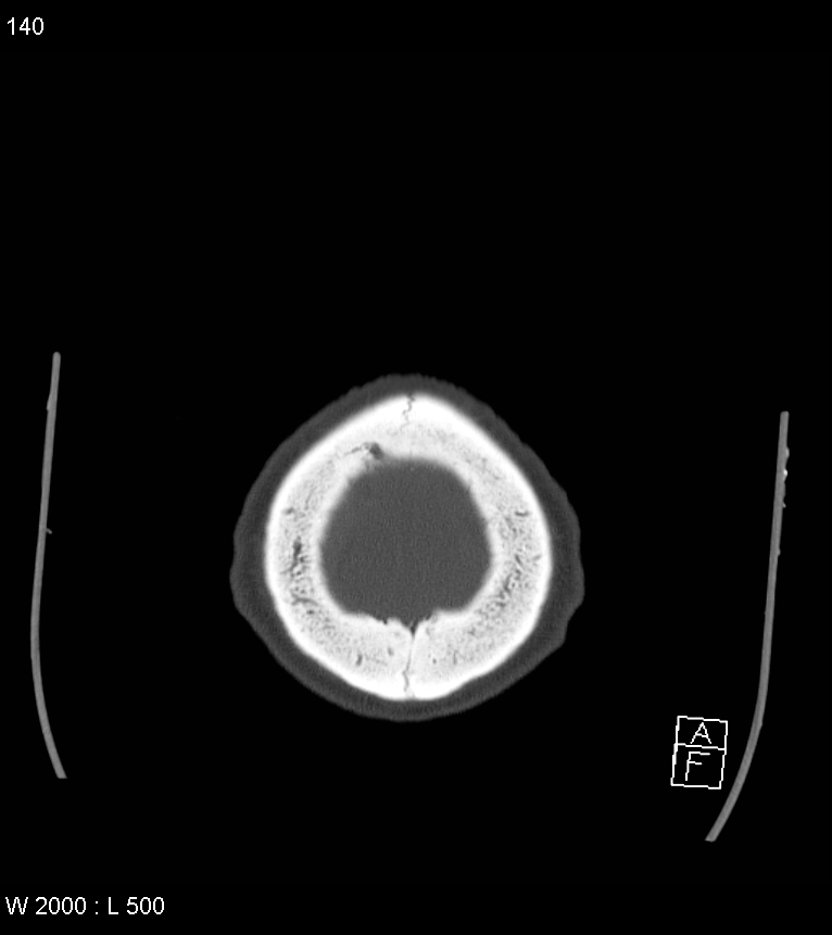 Acute subdural hematoma with myelofibrosis (Radiopaedia 52582-58494 Axial bone window 70).jpg