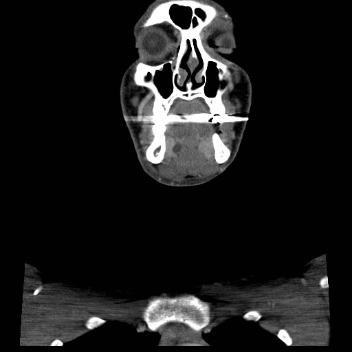 File:Acute submandibular sialadenitis secondary to ductal stone (Radiopaedia 27999-28267 D 13).jpg