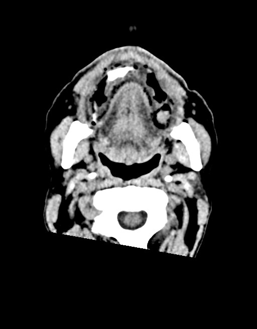 Acute superior cerebellar artery territory infarct (Radiopaedia 84104-99359 Axial non-contrast 75).jpg