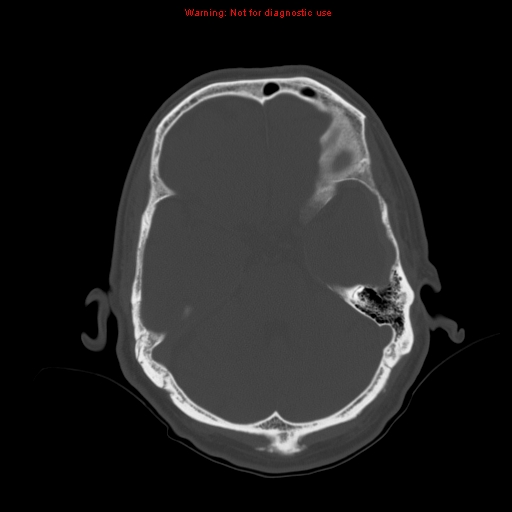 Acute suppurative pyelonephritis (Radiopaedia 18306-18147 Axial renal parenchymal phase 90).jpg