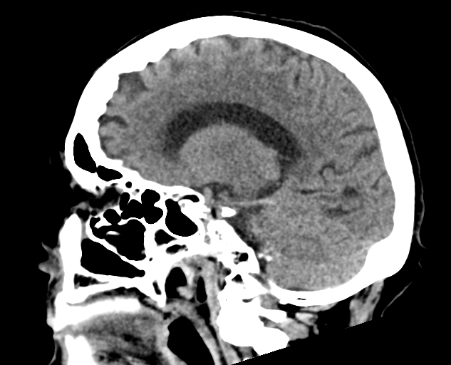 File:Acute traumatic subdural hematoma (Radiopaedia 82921-97257 Sagittal non-contrast 32).jpg