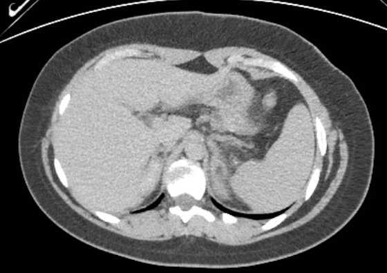 Acute unilateral nonhemorrhagic adrenal infarction (Radiopaedia 67560-76957 Axial renal excretory phase 20).jpg