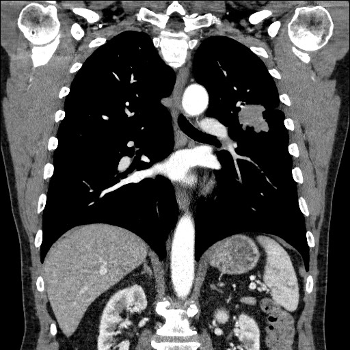 Adenocarcinoma of the lung (Radiopaedia 59871-67325 Coronal C+ arterial phase 42).jpg