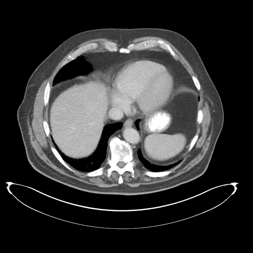 File:Adenocarcioma of rectum- T1 lesion (Radiopaedia 36921-38547 Axial C+ portal venous phase 12).png