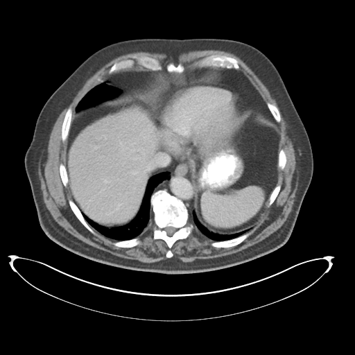 Adenocarcioma of rectum- T1 lesion (Radiopaedia 36921-38547 Axial C+ portal venous phase 13).png