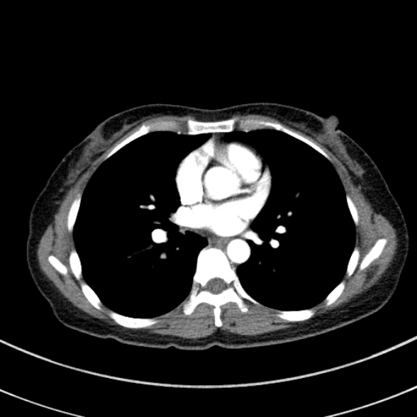 Adenocystic carcinoma of the trachea (Radiopaedia 47677-52525 Axial C+ arterial phase 54).jpg