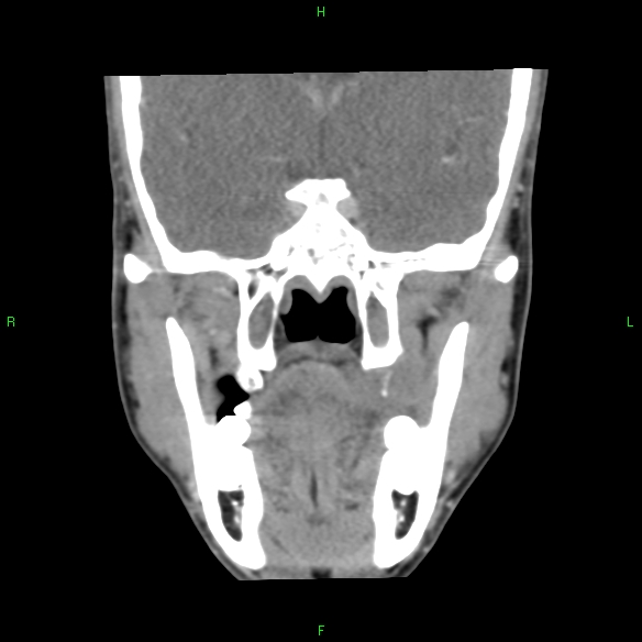 File:Adenoid cystic carcinoma of hard palate (Radiopaedia 26137-26273 Coronal liver window 16).jpg