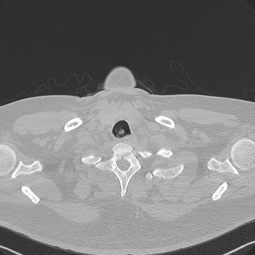 Adenoid cystic carcinoma of the trachea (Radiopaedia 49042-54137 Axial lung window 12).jpg
