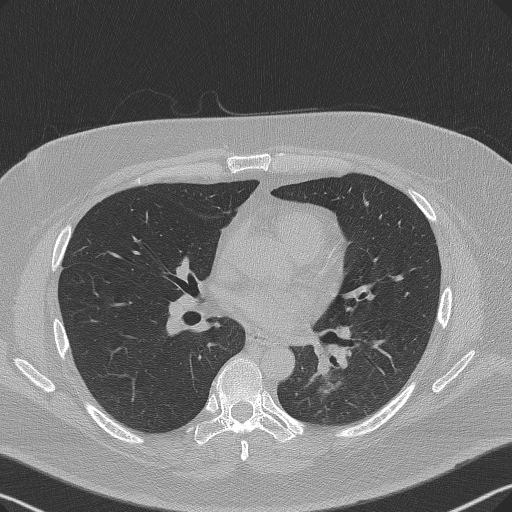 Adenoid cystic carcinoma of the trachea (Radiopaedia 49042-54137 Axial lung window 186).jpg