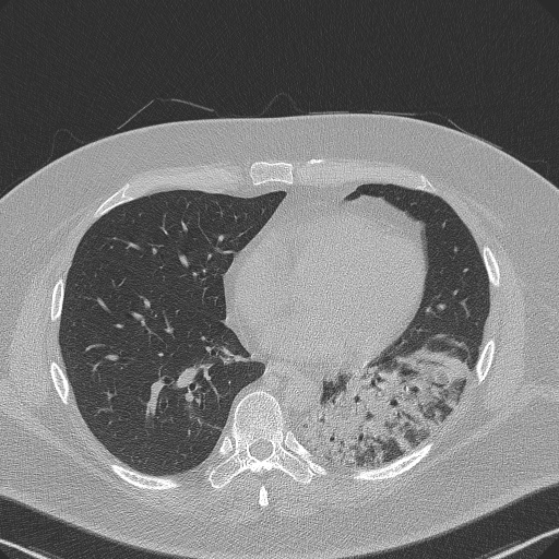 Adenoid cystic carcinoma of the trachea (Radiopaedia 49042-54137 Axial lung window 222).jpg