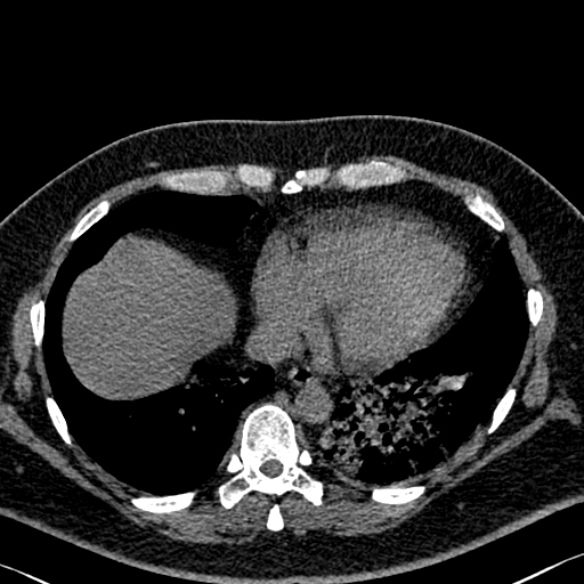 Adenoid cystic carcinoma of the trachea (Radiopaedia 49042-54137 Axial non-contrast 259).jpg