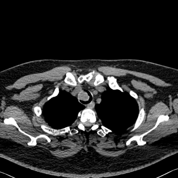 Adenoid cystic carcinoma of the trachea (Radiopaedia 49042-54137 Axial non-contrast 49).jpg