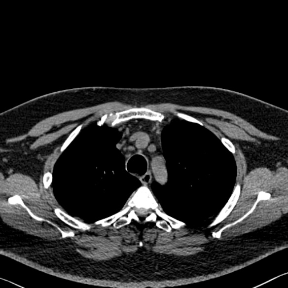 Adenoid cystic carcinoma of the trachea (Radiopaedia 49042-54137 Axial non-contrast 81).jpg