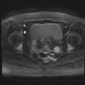 File:Adenomyosis and endometriotic cysts (Radiopaedia 82300-96367 Axial DWI 26).jpg