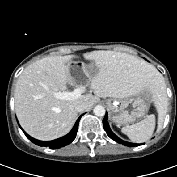 Adhesional small bowel obstruction (Radiopaedia 48397-53305 Axial C+ portal venous phase 11).jpg