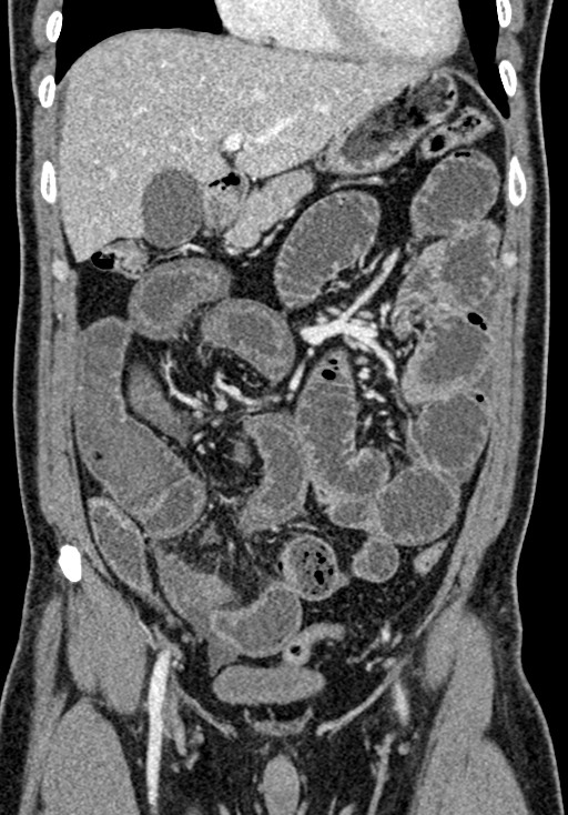 Adhesional small bowel obstruction (Radiopaedia 58900-66131 Coronal C+ portal venous phase 110).jpg