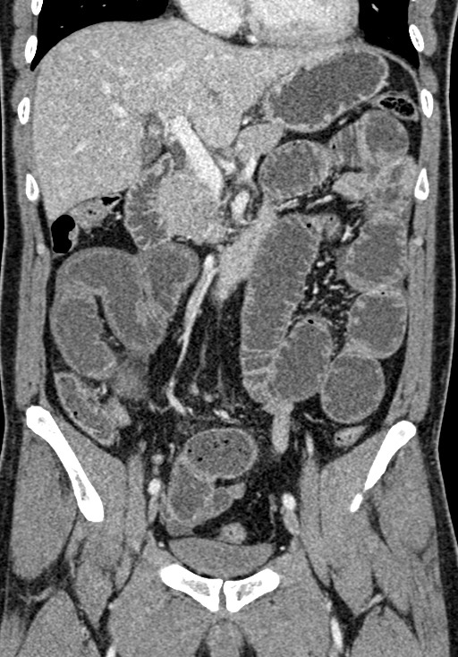 Adhesional small bowel obstruction (Radiopaedia 58900-66131 Coronal C+ portal venous phase 128).jpg