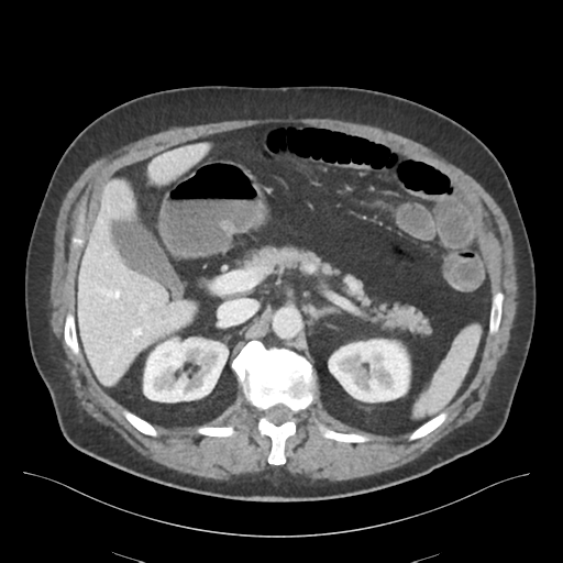 Adhesions within abdominal wall hernia (Radiopaedia 58283-65394 Axial C+ portal venous phase 28).png