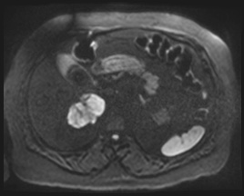 File:Adrenal cortical carcinoma (Radiopaedia 64017-72770 Axial DWI 100).jpg