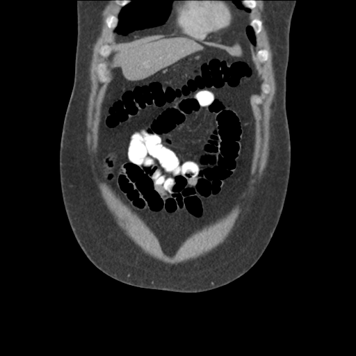 Adrenal cyst (Radiopaedia 45625-49776 Coronal C+ portal venous phase 17).png
