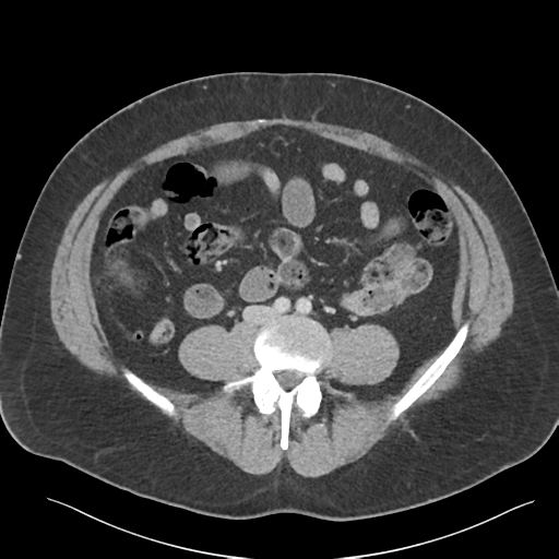 Adrenal cyst (Radiopaedia 45625-49777 Axial C+ portal venous phase 64).png