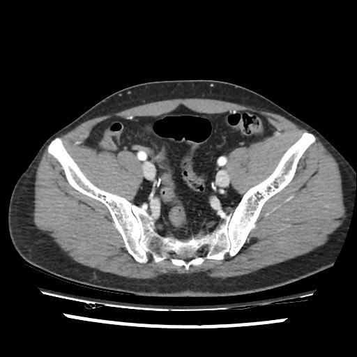 Adrenal gland trauma (Radiopaedia 81351-95078 Axial Dual bolus trauma C+ 105).jpg
