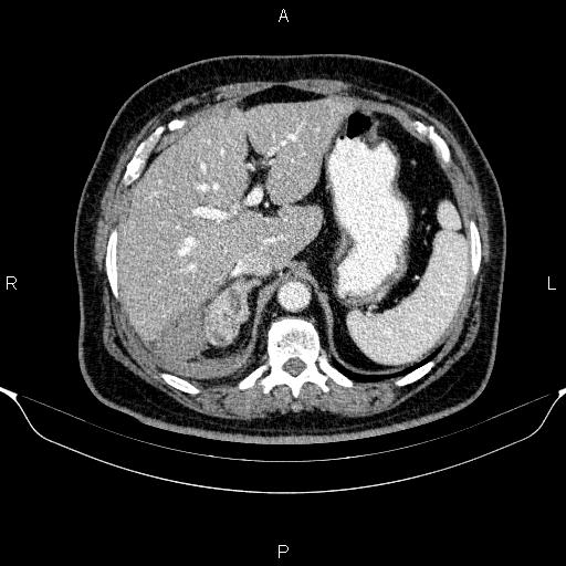 Adrenal hemorrhage (Radiopaedia 62622-70916 Axial C+ portal venous phase 38).jpg