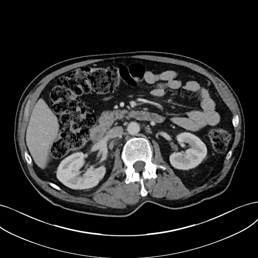 Adrenal lymphoma (Radiopaedia 73730-84529 Axial C+ portal venous phase 48).jpg