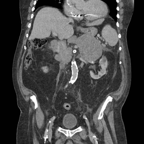 Adrenal lymphoma (Radiopaedia 84145-99415 Coronal C+ portal venous phase 41).jpg