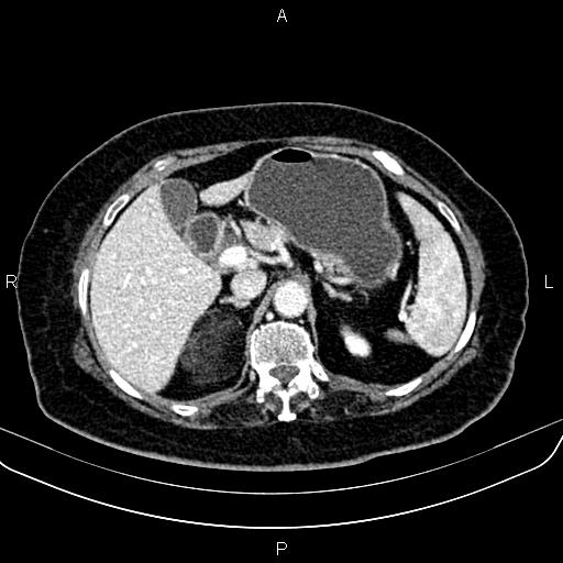 Adrenal myelolipoma (Radiopaedia 82742-96986 Axial renal cortical phase 49).jpg