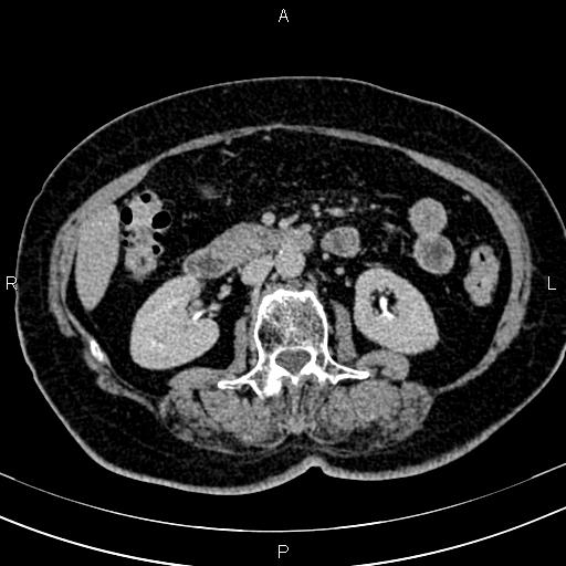 Adrenal myelolipoma (Radiopaedia 82742-96986 Axial renal excretory phase 68).jpg