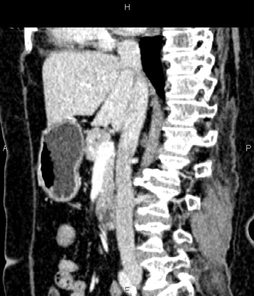 Adrenal myelolipoma (Radiopaedia 82742-96986 Sagittal renal cortical phase 52).jpg