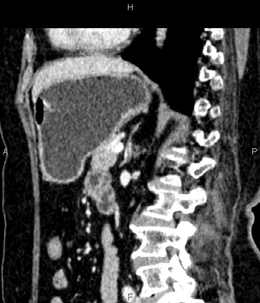 Adrenal myelolipoma (Radiopaedia 82742-96986 Sagittal renal cortical phase 65).jpg