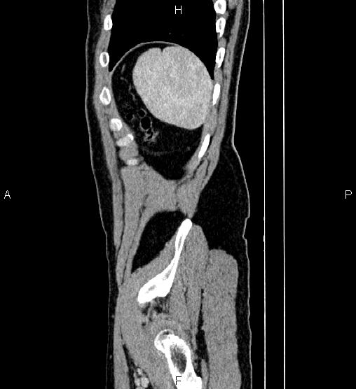 Adrenal myelolipoma (Radiopaedia 87794-104246 Sagittal renal cortical phase 85).jpg